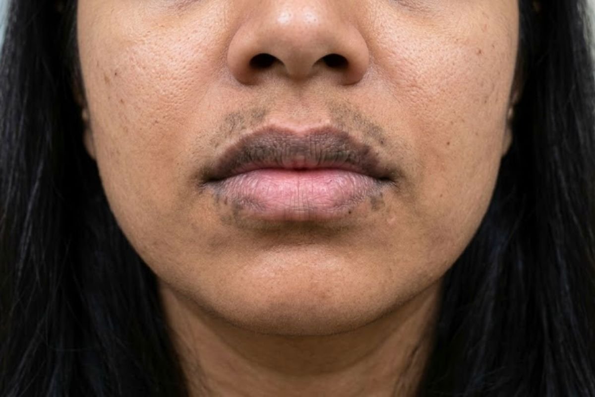Before treatment